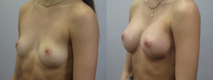 Breast Augmentation Case 1577 Before & After Left Oblique | Paramus, New Jersey | Parker Center for Plastic Surgery