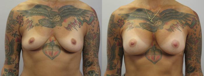 Breast Augmentation Case 1624 Before & After Front | Paramus, New Jersey | Parker Center for Plastic Surgery