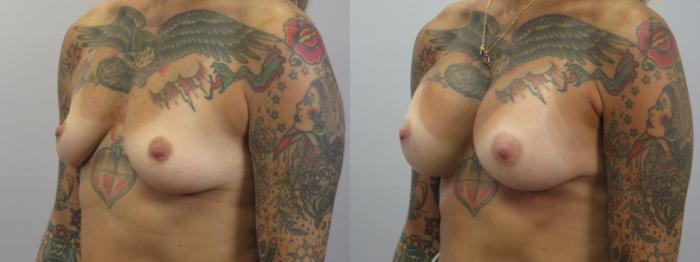 Breast Augmentation Case 1624 Before & After Left Oblique | Paramus, New Jersey | Parker Center for Plastic Surgery
