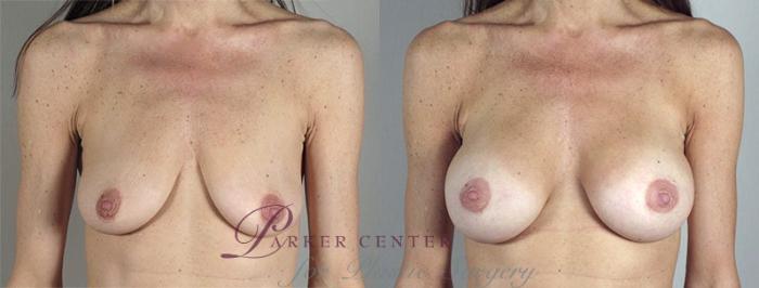 Breast Augmentation Case 346 Before & After View #1 | Paramus, NJ | Parker Center for Plastic Surgery