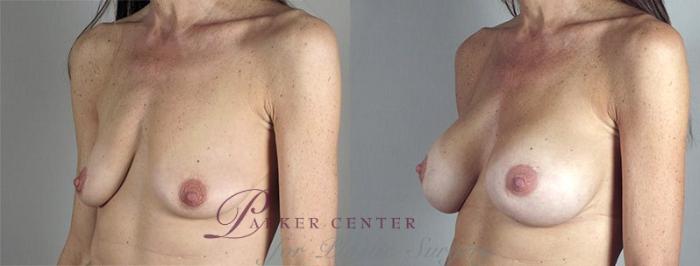Breast Augmentation Case 346 Before & After View #2 | Paramus, NJ | Parker Center for Plastic Surgery
