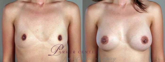 Breast Augmentation Case 347 Before & After View #1 | Paramus, NJ | Parker Center for Plastic Surgery