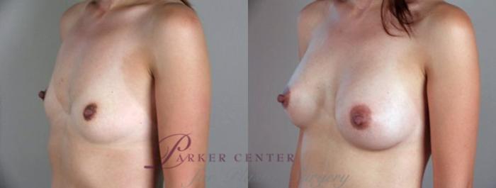 Breast Augmentation Case 347 Before & After View #2 | Paramus, NJ | Parker Center for Plastic Surgery