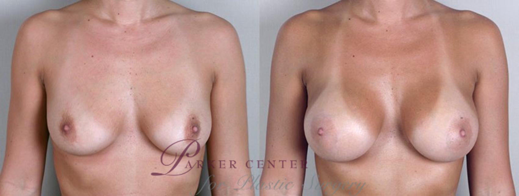 Breast Augmentation Case 348 Before & After View #1 | Paramus, NJ | Parker Center for Plastic Surgery