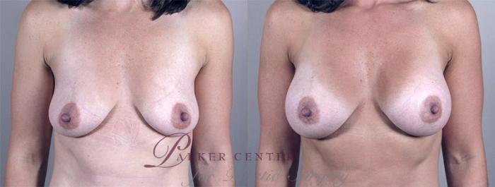 Breast Augmentation Case 349 Before & After View #1 | Paramus, NJ | Parker Center for Plastic Surgery