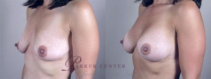 Breast Augmentation Case 349 Before & After View #2 | Paramus, NJ | Parker Center for Plastic Surgery