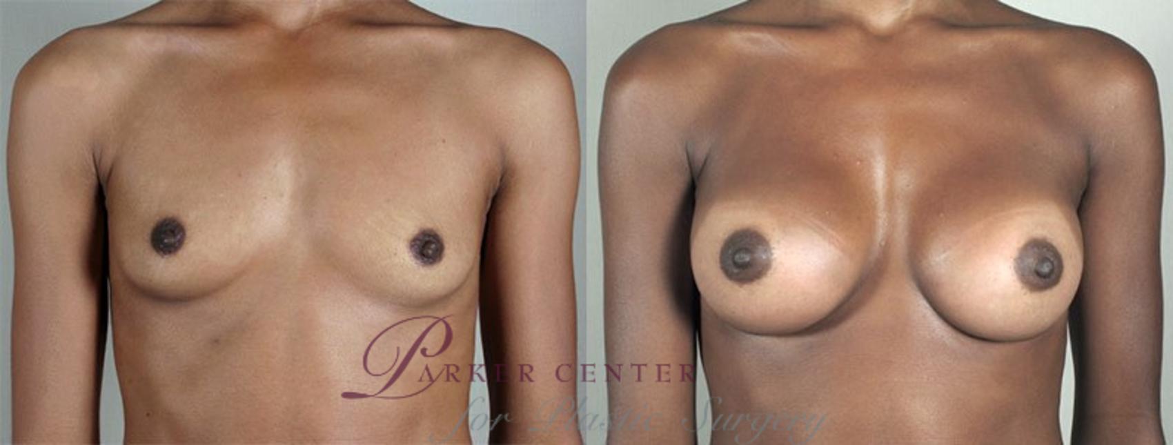 Breast Augmentation Case 350 Before & After View #1 | Paramus, NJ | Parker Center for Plastic Surgery