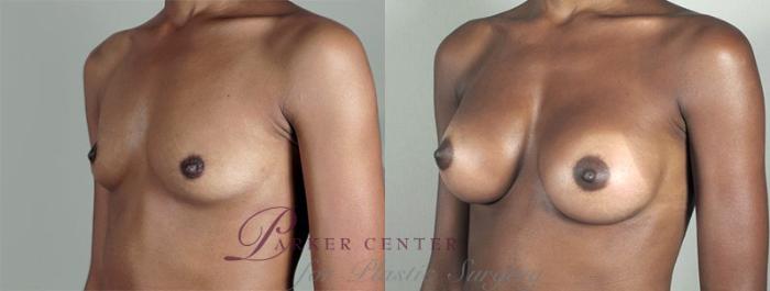 Breast Augmentation Case 350 Before & After View #2 | Paramus, NJ | Parker Center for Plastic Surgery