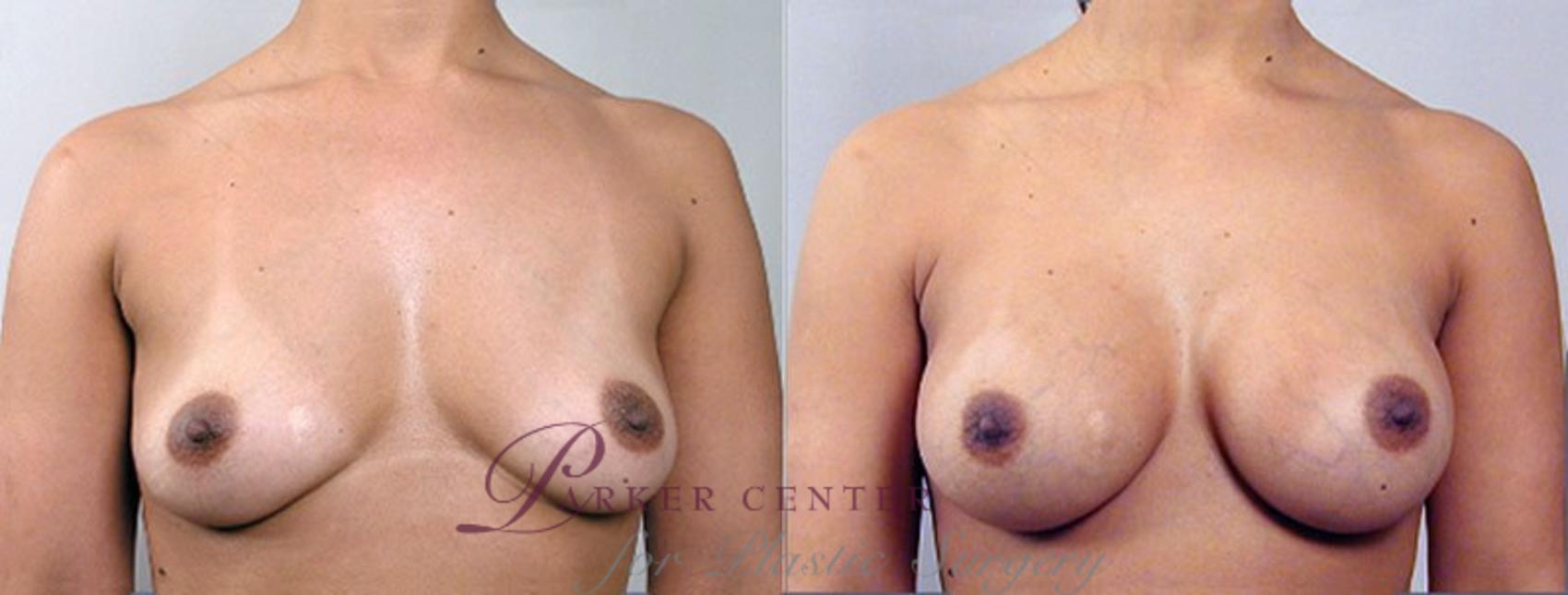 Breast Augmentation Case 351 Before & After View #1 | Paramus, NJ | Parker Center for Plastic Surgery