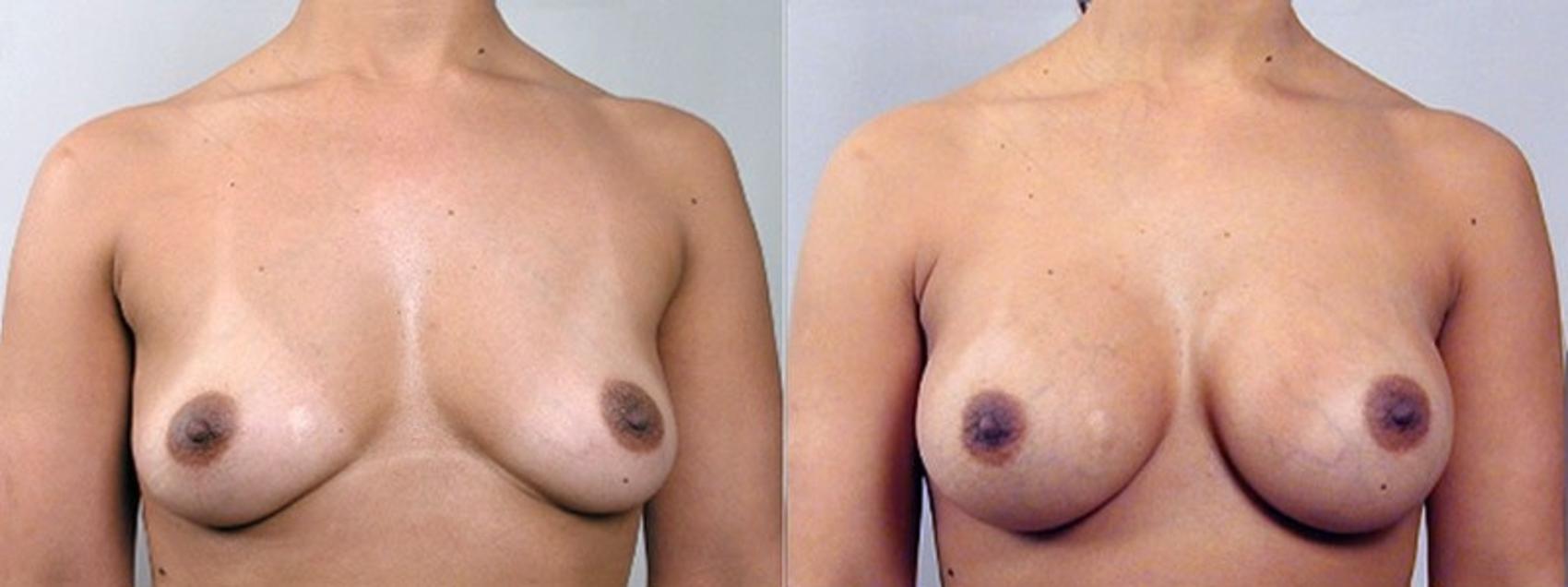 Breast Augmentation Case 351 Before & After View #1 | Paramus, New Jersey | Parker Center for Plastic Surgery