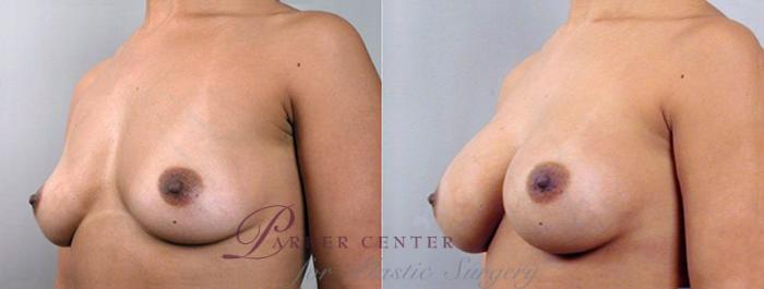 Breast Augmentation Case 351 Before & After View #2 | Paramus, NJ | Parker Center for Plastic Surgery