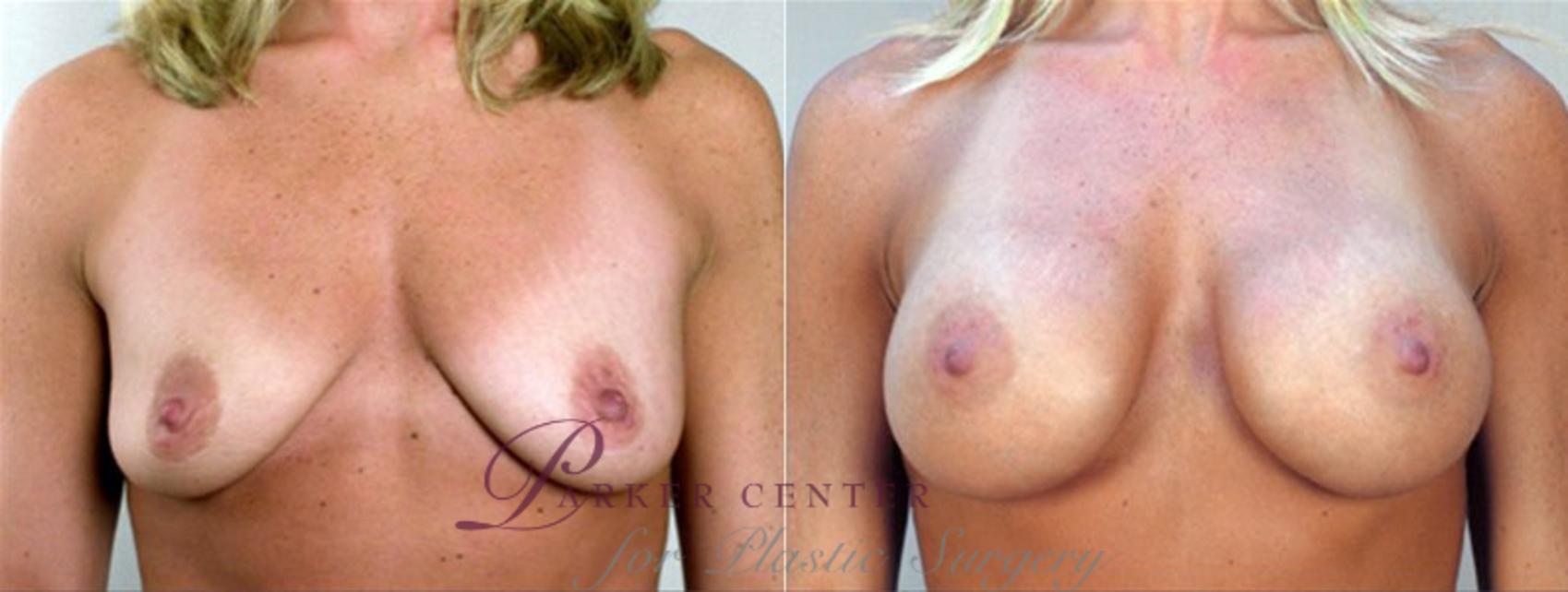 Breast Augmentation Case 352 Before & After View #1 | Paramus, NJ | Parker Center for Plastic Surgery