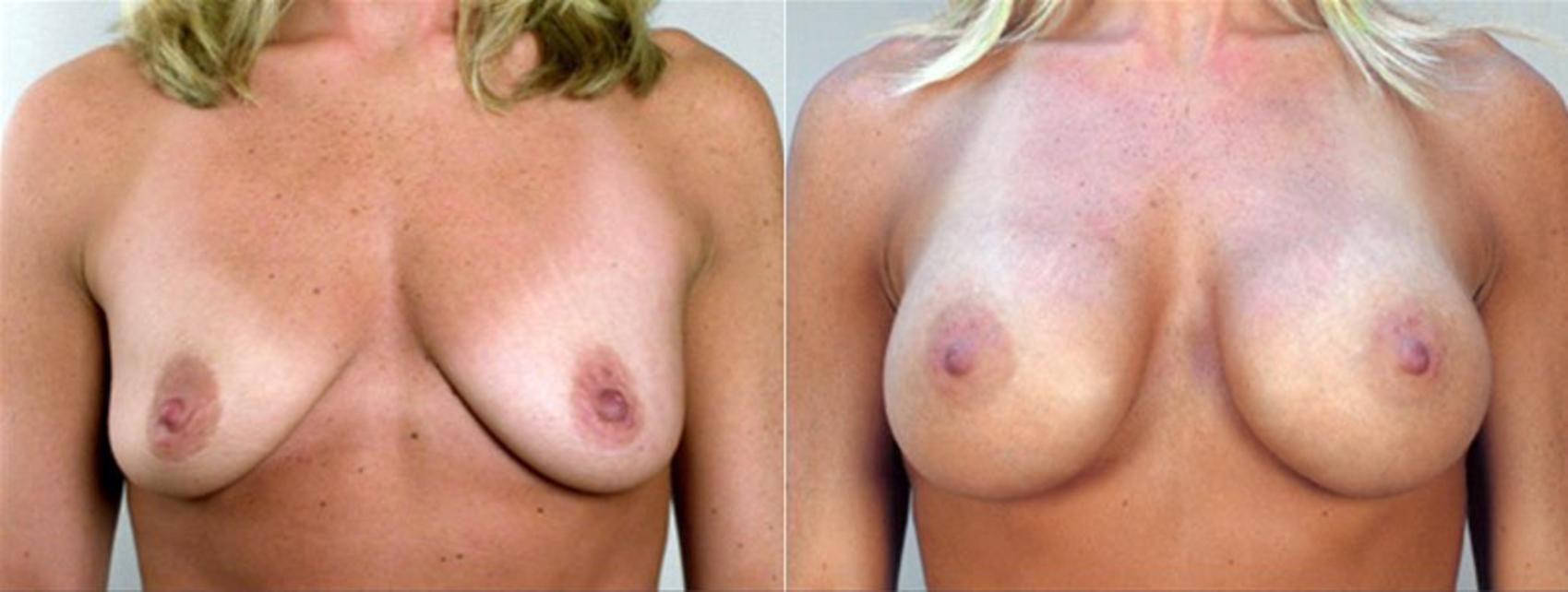 Breast Augmentation Case 352 Before & After View #1 | Paramus, New Jersey | Parker Center for Plastic Surgery