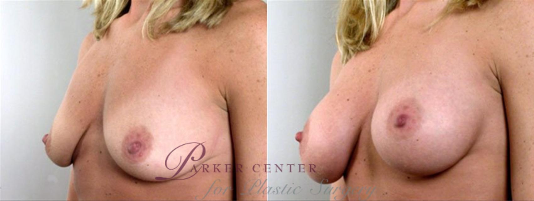 Breast Augmentation Case 352 Before & After View #2 | Paramus, NJ | Parker Center for Plastic Surgery