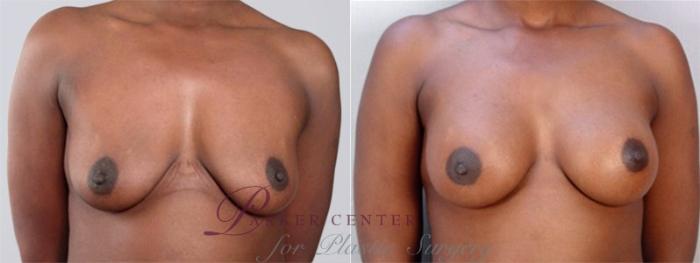 Breast Augmentation Case 353 Before & After View #1 | Paramus, NJ | Parker Center for Plastic Surgery