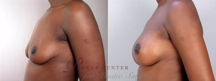 Breast Augmentation Case 353 Before & After View #2 | Paramus, NJ | Parker Center for Plastic Surgery