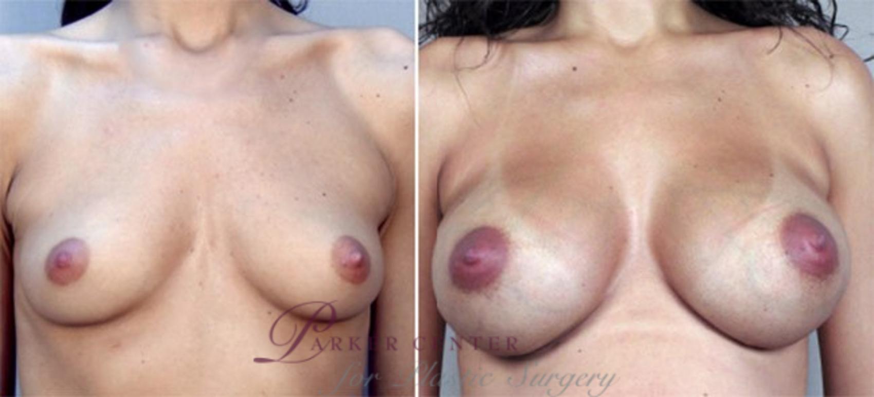 Breast Augmentation Case 354 Before & After View #1 | Paramus, NJ | Parker Center for Plastic Surgery