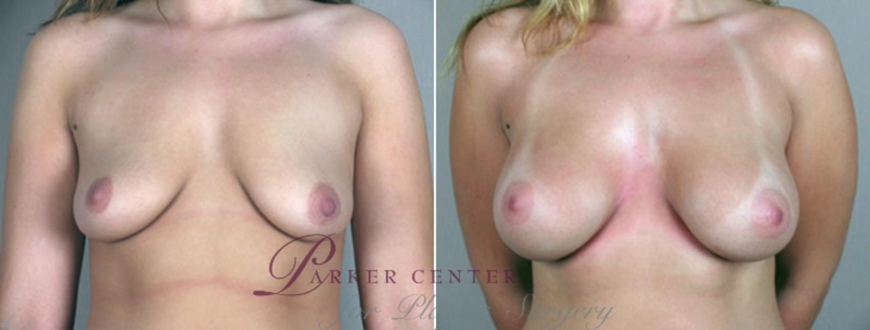 Breast Augmentation Case 355 Before & After View #1 | Paramus, NJ | Parker Center for Plastic Surgery