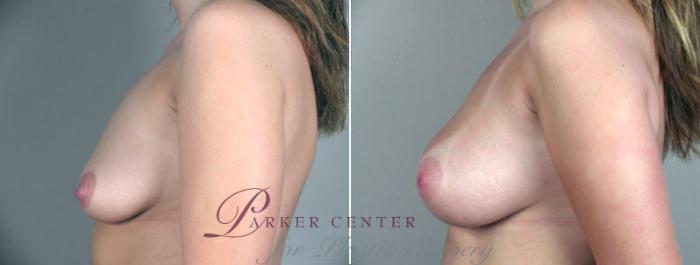 Breast Augmentation Case 355 Before & After View #2 | Paramus, NJ | Parker Center for Plastic Surgery