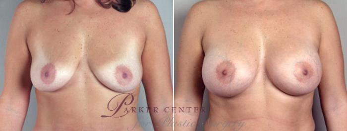Breast Augmentation Case 356 Before & After View #1 | Paramus, NJ | Parker Center for Plastic Surgery