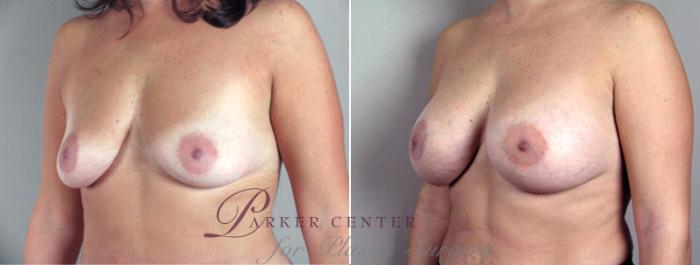 Breast Augmentation Case 356 Before & After View #2 | Paramus, NJ | Parker Center for Plastic Surgery