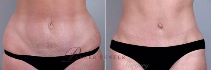 Mommy Makeover Case 356 Before & After View #3 | Paramus, NJ | Parker Center for Plastic Surgery