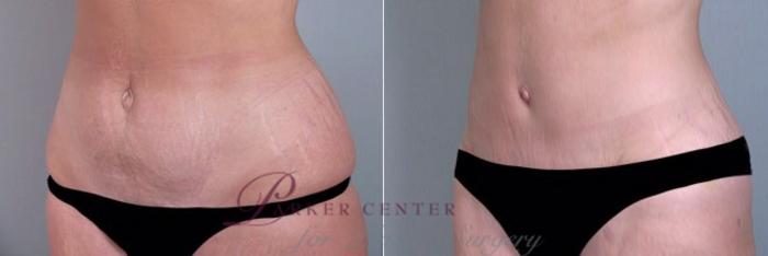 Mommy Makeover Case 356 Before & After View #4 | Paramus, NJ | Parker Center for Plastic Surgery