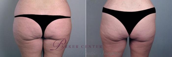 Mommy Makeover Case 356 Before & After View #5 | Paramus, NJ | Parker Center for Plastic Surgery