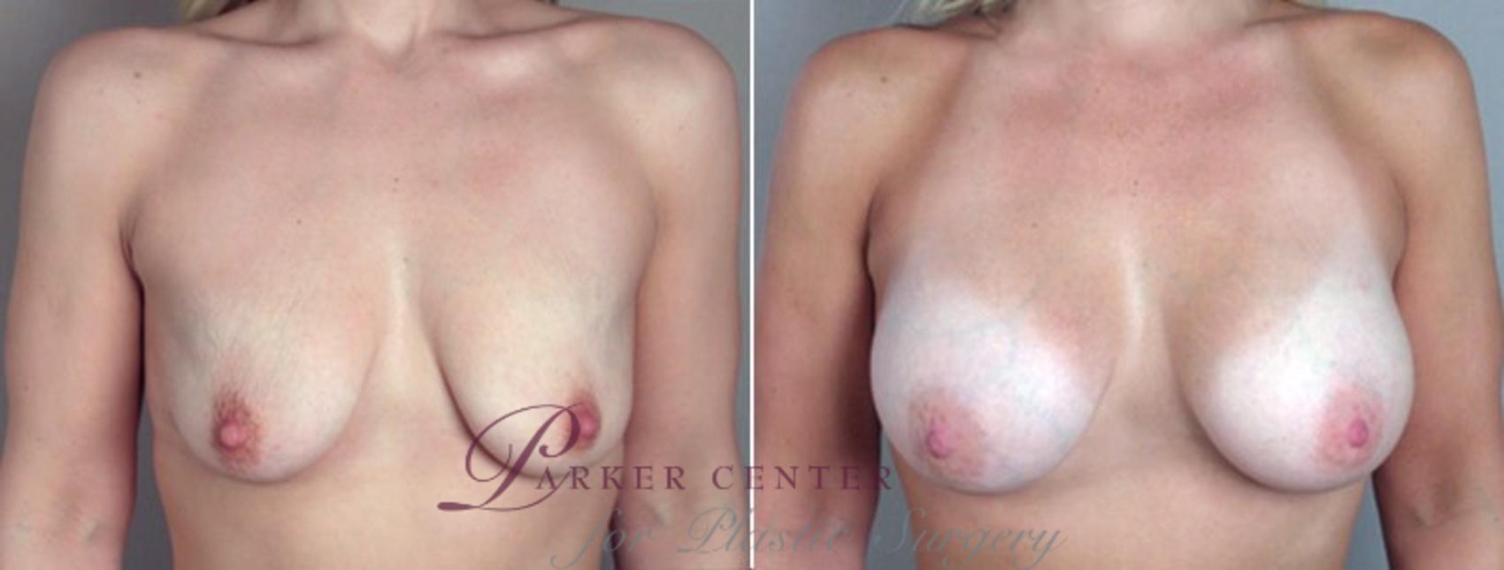 Breast Augmentation Case 357 Before & After View #1 | Paramus, NJ | Parker Center for Plastic Surgery