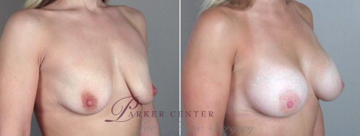 Breast Augmentation Case 357 Before & After View #2 | Paramus, NJ | Parker Center for Plastic Surgery