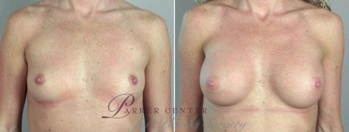 Breast Augmentation Case 358 Before & After View #1 | Paramus, NJ | Parker Center for Plastic Surgery