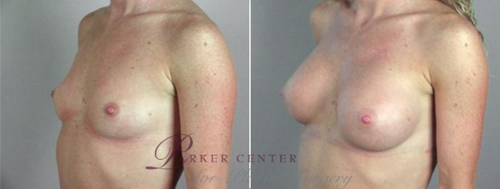 Breast Augmentation Case 358 Before & After View #2 | Paramus, NJ | Parker Center for Plastic Surgery