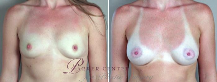 Breast Augmentation Case 359 Before & After View #1 | Paramus, NJ | Parker Center for Plastic Surgery