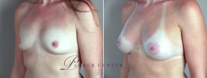 Breast Augmentation Case 359 Before & After View #2 | Paramus, NJ | Parker Center for Plastic Surgery