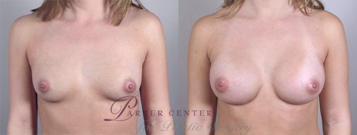 Breast Augmentation Case 360 Before & After View #1 | Paramus, NJ | Parker Center for Plastic Surgery