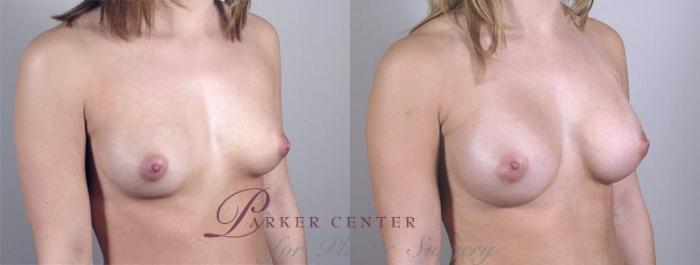 Breast Augmentation Case 360 Before & After View #2 | Paramus, NJ | Parker Center for Plastic Surgery