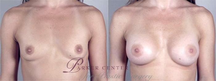 Breast Augmentation Case 361 Before & After View #1 | Paramus, NJ | Parker Center for Plastic Surgery