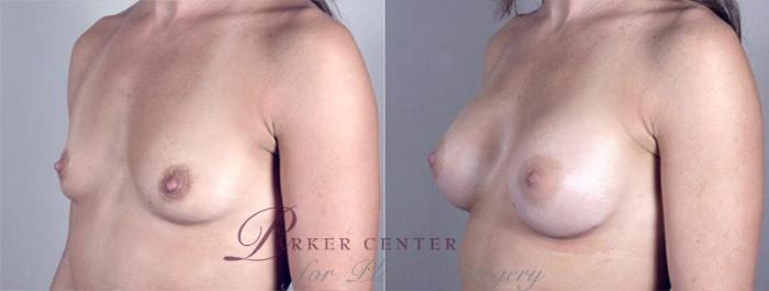 Breast Augmentation Case 361 Before & After View #2 | Paramus, NJ | Parker Center for Plastic Surgery