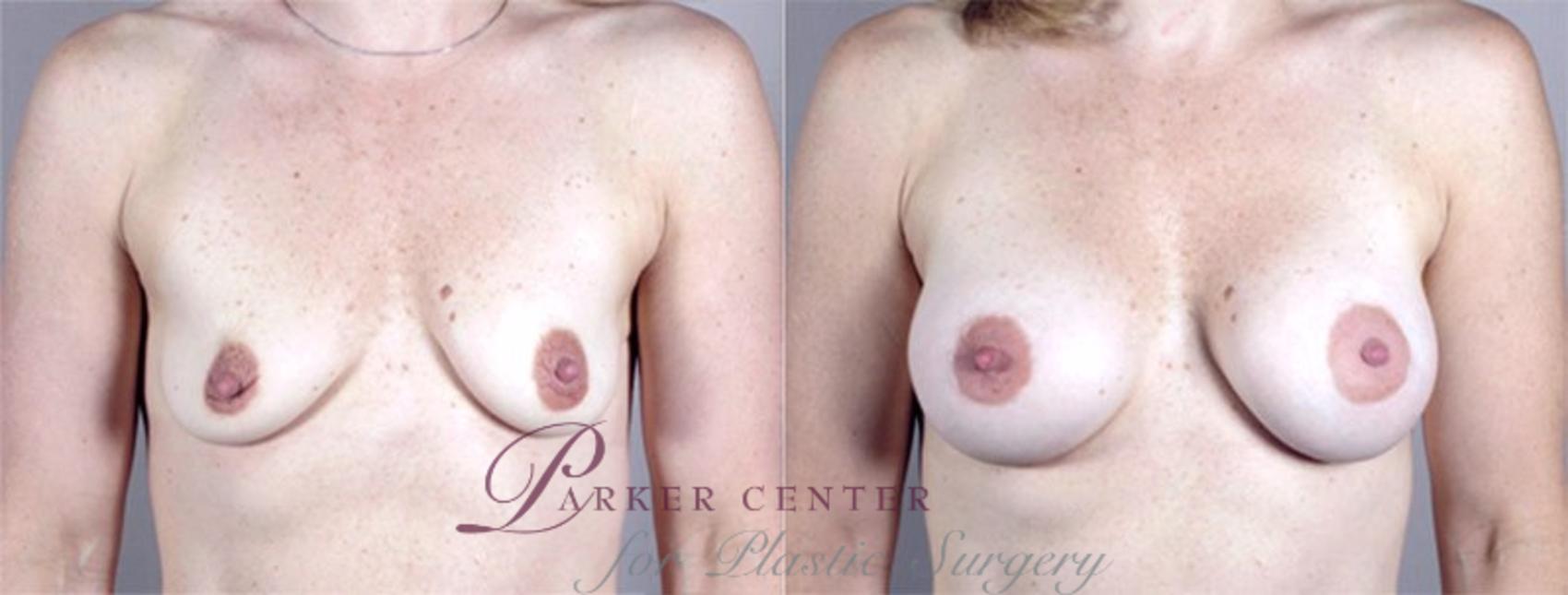 Breast Augmentation Case 362 Before & After View #1 | Paramus, NJ | Parker Center for Plastic Surgery