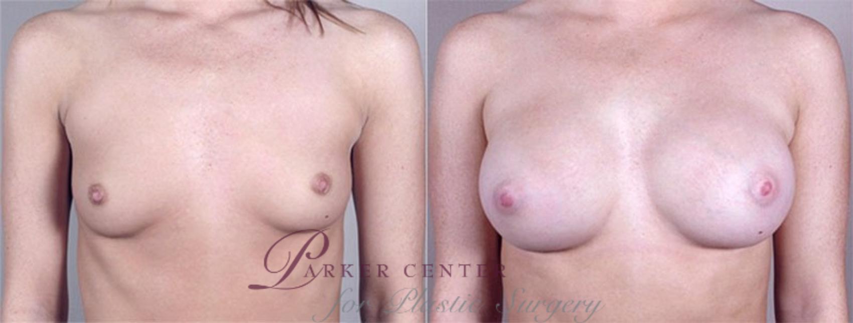 Breast Augmentation Case 364 Before & After View #1 | Paramus, NJ | Parker Center for Plastic Surgery