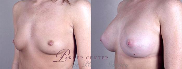 Breast Augmentation Case 364 Before & After View #2 | Paramus, NJ | Parker Center for Plastic Surgery