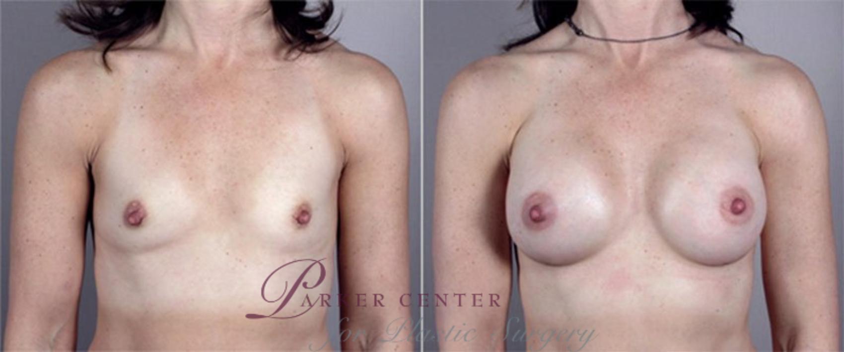 Breast Augmentation Case 365 Before & After View #1 | Paramus, NJ | Parker Center for Plastic Surgery