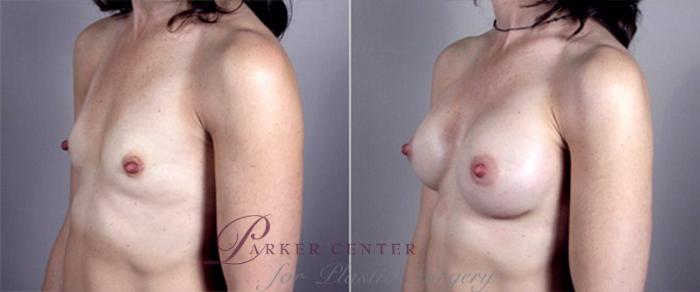Breast Augmentation Case 365 Before & After View #2 | Paramus, NJ | Parker Center for Plastic Surgery