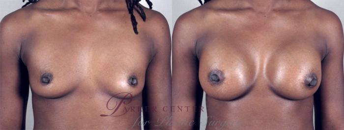 Breast Augmentation Case 366 Before & After View #1 | Paramus, NJ | Parker Center for Plastic Surgery