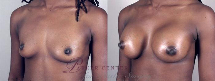 Breast Augmentation Case 366 Before & After View #2 | Paramus, NJ | Parker Center for Plastic Surgery