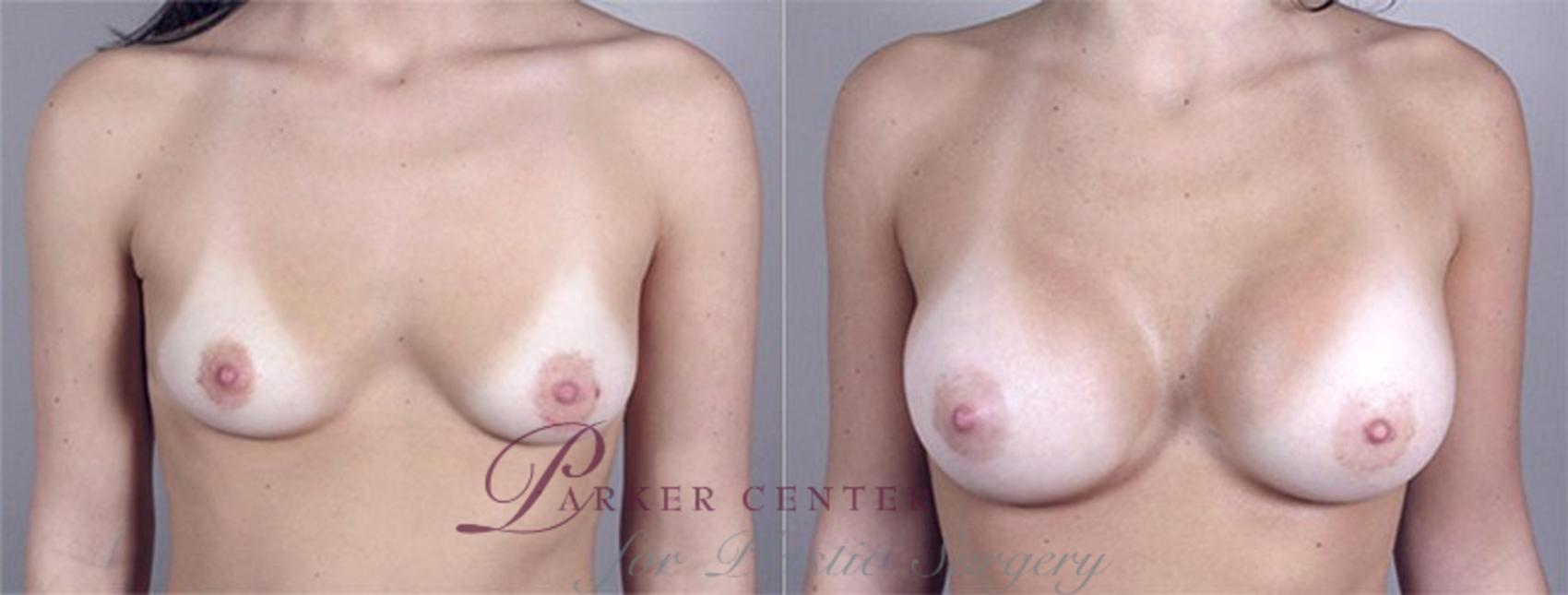 Breast Augmentation Case 367 Before & After View #1 | Paramus, NJ | Parker Center for Plastic Surgery