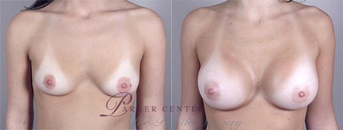 Breast Augmentation Case 367 Before & After View #1 | Paramus, NJ | Parker Center for Plastic Surgery