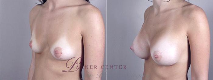 Breast Augmentation Case 367 Before & After View #2 | Paramus, NJ | Parker Center for Plastic Surgery