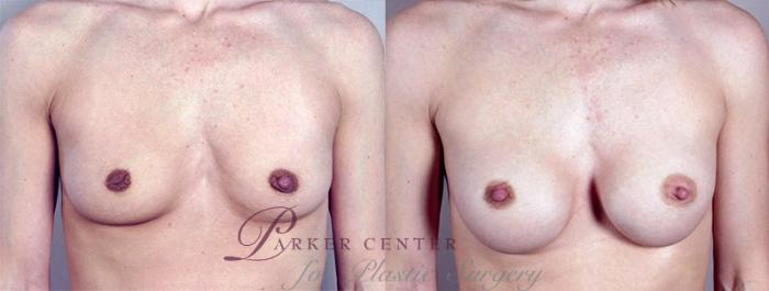 Breast Augmentation Case 368 Before & After View #1 | Paramus, NJ | Parker Center for Plastic Surgery