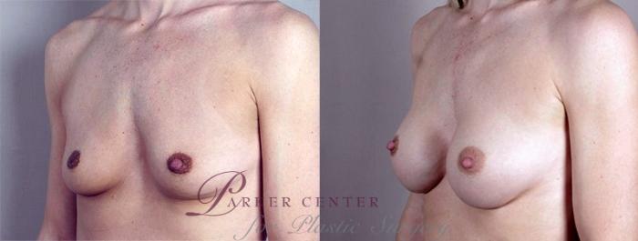 Breast Augmentation Case 368 Before & After View #2 | Paramus, NJ | Parker Center for Plastic Surgery